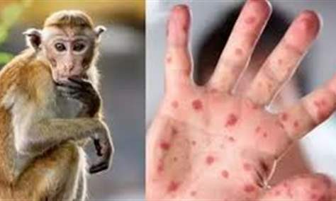 منظمة الصحة العالمية ترغب في تغيير اسم مرض “جدري القردة”